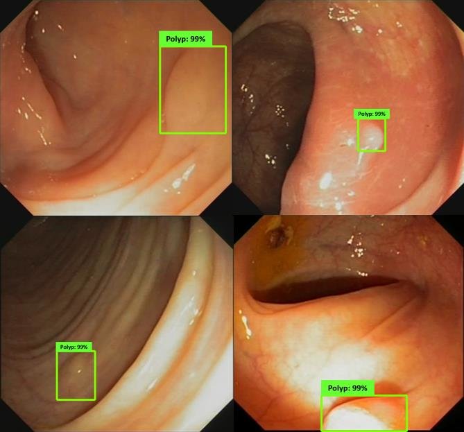 Colonoscopy Polyp Detection